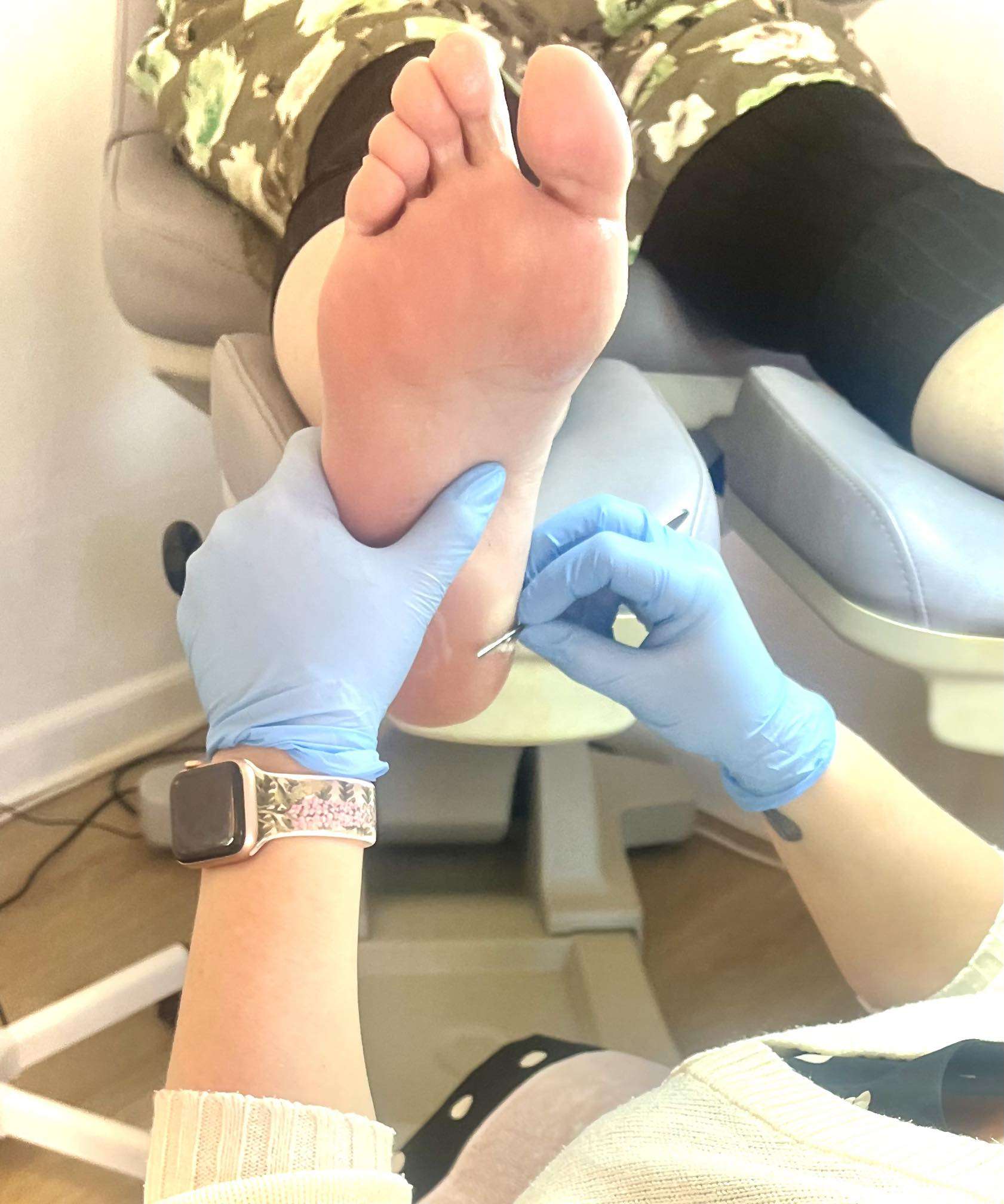 Fjernelse af hård hud og ligtorne på fødderne ved fodbehandling i Frederiksværk af vores fodplejer i klinikken